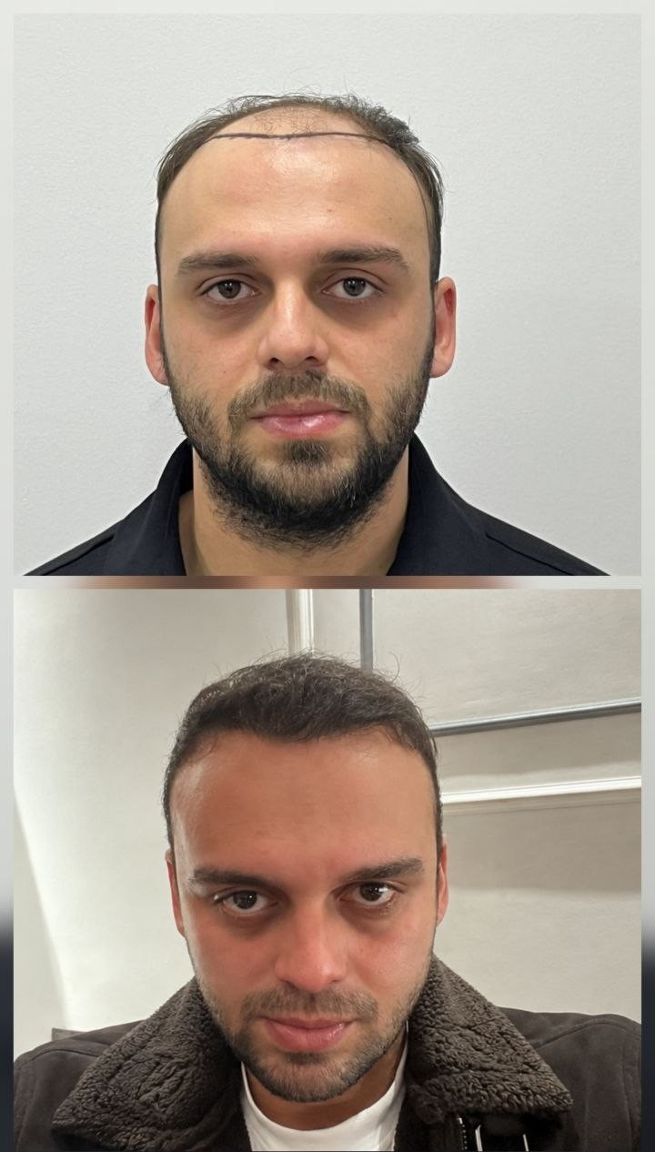 Saç ekimi öncesi ve sonrası — vaka 1
