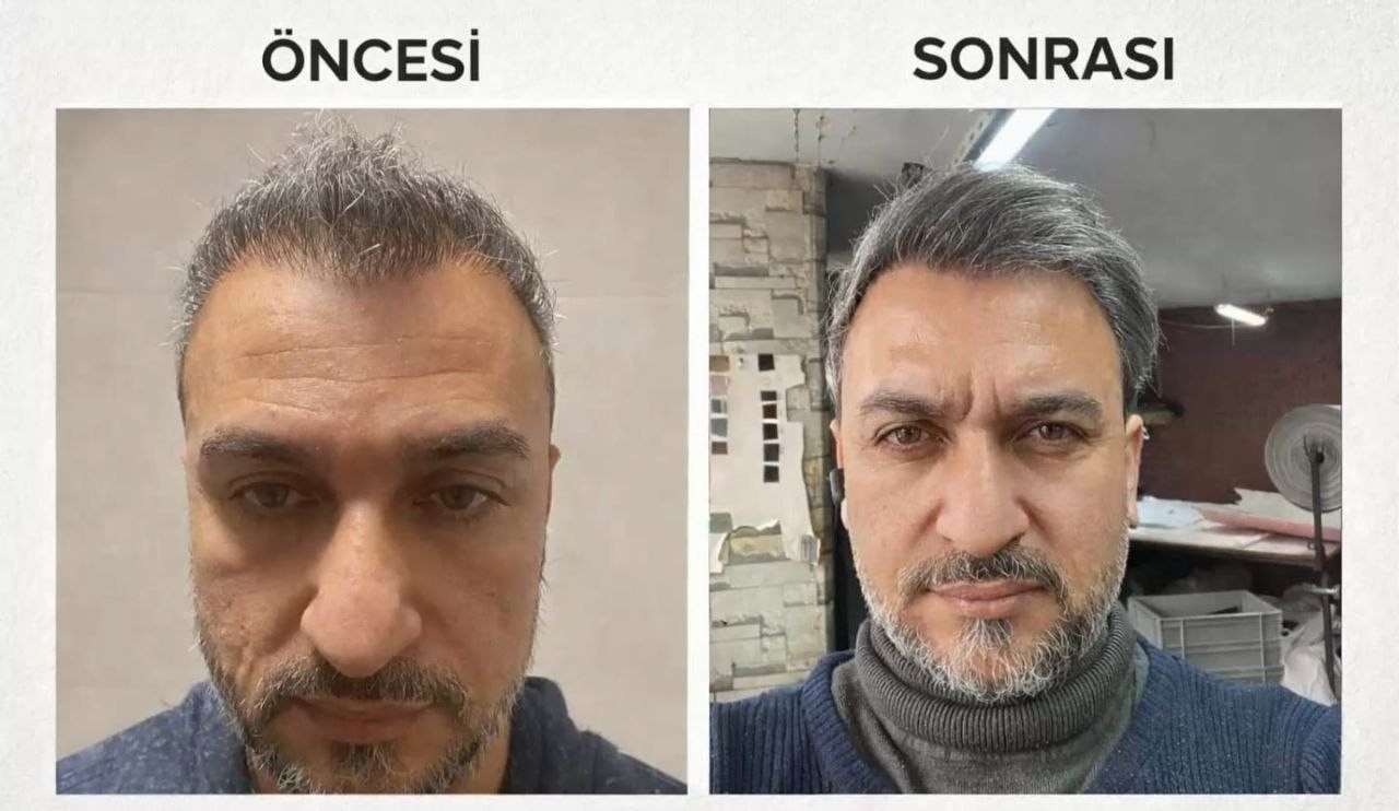Saç ekimi öncesi ve sonrası — vaka 28