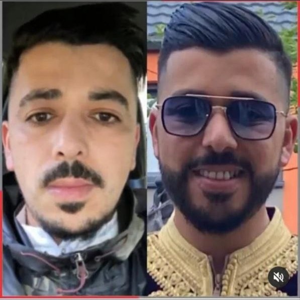 Saç ekimi öncesi ve sonrası — vaka 32