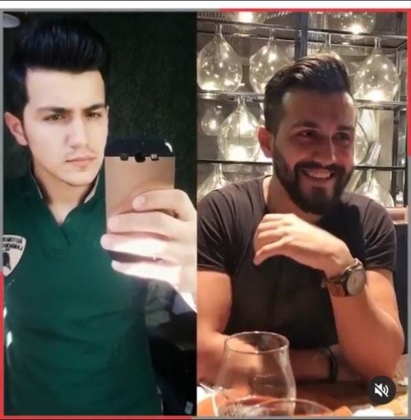 Saç ekimi öncesi ve sonrası — vaka 31